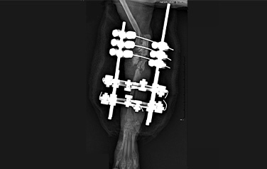 External skeletal fixation(ESF)